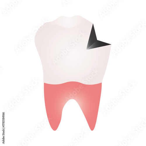 Broken Molar tooth 