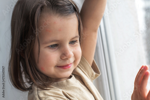 Little girl standing by the window with mosquito bites visible on her face, smiling softly, showing natural skin reaction and everyday moments of childhood during summer