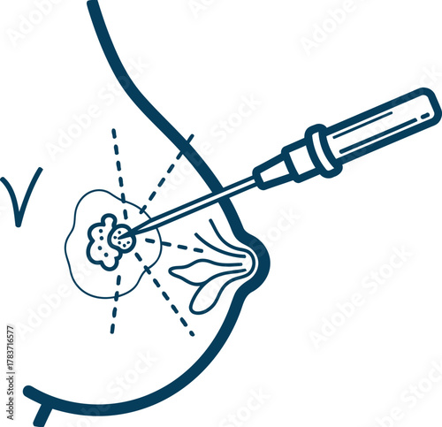 Breast biopsy procedure medical illustration for healthcare and awareness campaigns