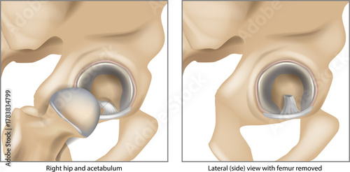 Anatomy of the right hip joint and acetabulum showing the acetabular labrum and ligamentum teres. Femoral head removed on right. arthroscopic ligamentum teres debridement, resection