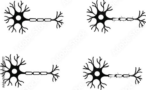 comparison of healthy and damaged human neuron cells with intact and demyelinated myelin sheath vector illustration 