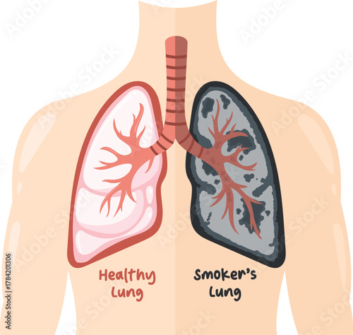 Healthy Lung vs Smoker's Lung The Impact of Smoking