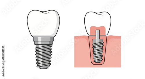 dental implant process showing tooth replacement and jaw integration