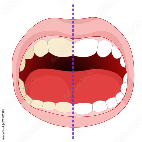 Teeth whitening  before after.  Home and office type tooth bleaching. Vector illustration