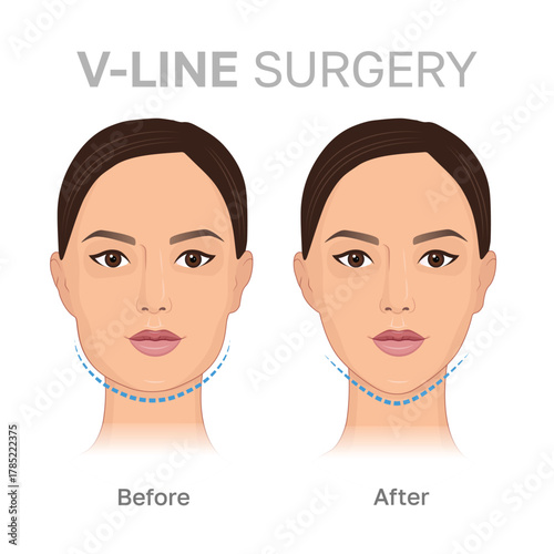 Vector illustration showing before and after mandibuloplasty. V-line jaw reduction. Can be used for medical, beauty, and cosmetic surgery-related content.
