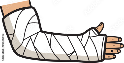 Broken Arm in Cast Graphic. Medical injury, recovery, and healthcare illustration for clinic or hospital