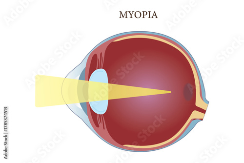 Medical illustration showing myopia with light focusing before the retina. eps 10