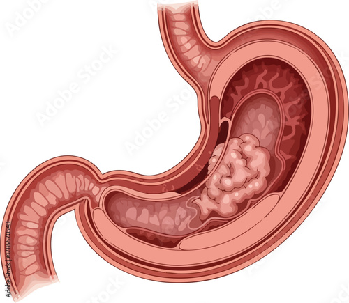 Medical illustration showing a cross-section of the stomach with a tumor indicating stomach cancer