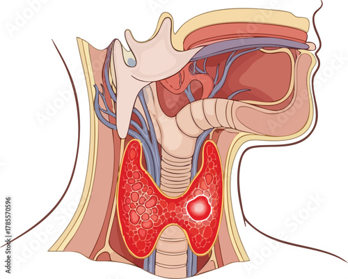 Detailed illustration of a cancerous thyroid gland, highlighting a visible tumor, crucial for medical education and research into thyroid cancer treatments