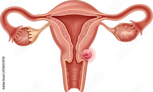 Uterine fibroid, a common non-cancerous growth, may be mistaken for early signs of uterine cancer