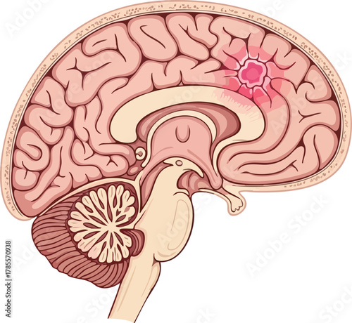 Illustration of Brain Cancer, Showing a Tumor Causing Damage and Inflammation