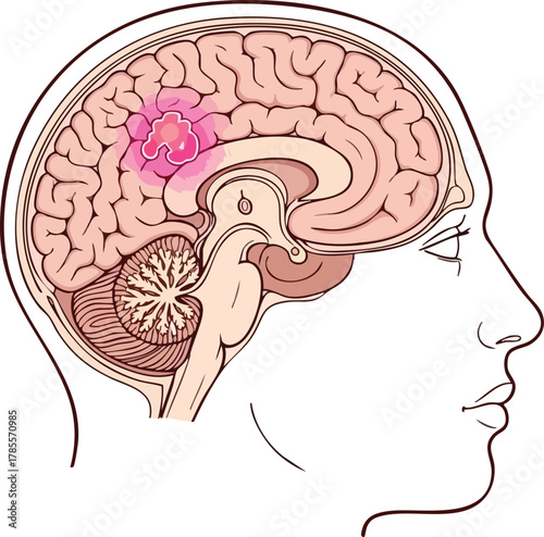 Illustration of a brain with a tumor highlighted, representing the concept of brain cancer and its impact on neurological health