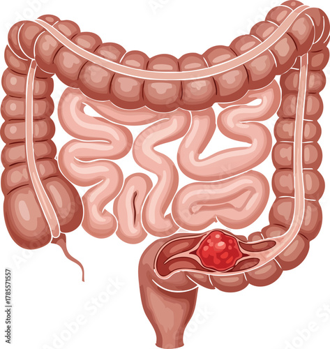 Illustration of a cancerous polyp within the colon, representing the dangers of colon cancer and the importance of early detection