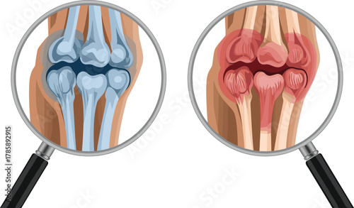 Healthy vs arthritic knee, joint comparison, cartilage damage, inflammation illustration, medical concept, magnified view, arthritis awareness, anatomy diagram, health education