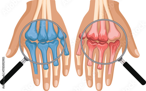Human hand bone comparison, medical anatomy illustration, magnified skeletal structure, blue and red bones, healthcare education vector, orthopedic chart