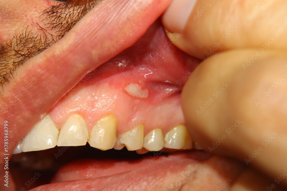 Obraz premium Close-up painful gum ulcer shows a white irritated center and a surrounding red inflamed area on the inner gum. Ideal for dental medicine, oral care education, symptom and healthcare awareness content