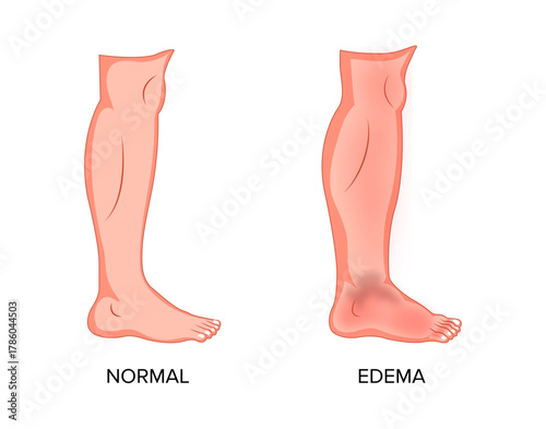 Swollen Foot and Ankle Compared With Normal Foot – Medical Vector Illustration