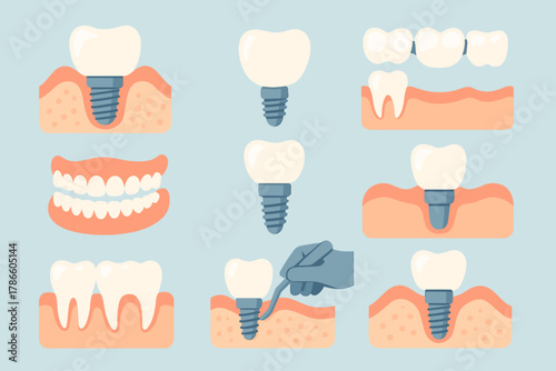 Dental Implant Procedure and Prosthetics Illustration — Tooth Restoration Stages and Oral Care
