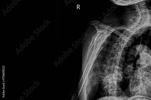 Shoulder X-ray showing humerus, scapula, clavicle, ribcage and thoracic spine. Medical diagnostic imaging for shoulder evaluation, chest assessment and orthopedic analysis of upper body skeletal struc