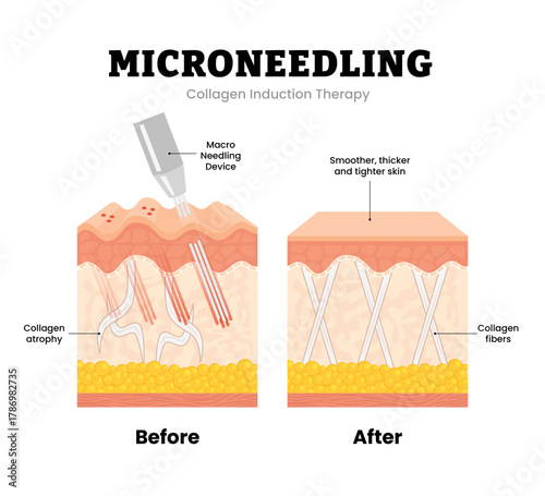 Before after microneedling procedure. Collagen induction therapy. Skin rejuvenation anti aging treatment. Remove wrinkles, scars, stretch, marks. Human skin layers anatomy cross section. illustration.