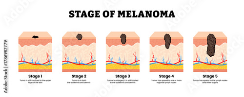 Stages of melanoma stage. The TNM classification of malignant tumors. Skin cancer metastasis. Human skin layers anatomy cross section. Vector illustration.