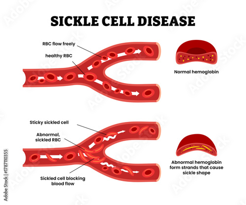 Sickle cell disease with abnormal red blood cells that blocking blood flow. Chronic vascular condition. Vector illustration. Abnormal hemoglobin. Inherited blood disorder. Vector illustration