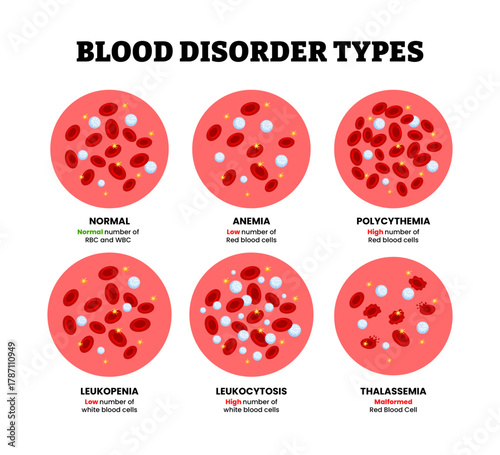 Different types of blood disorder types, Anemia, polycythemia, leukopenia,leukocytosis,thalassemia blood specimen blood composition comparison. Thrombocytes, leukocytes, erythrocytes under microscope.