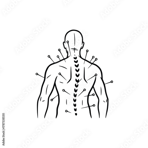 Acupuncture Treatment Needles in Back for Pain Relief.