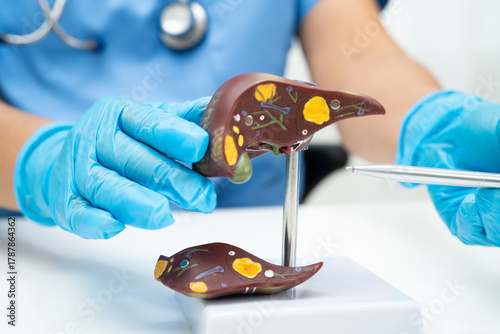 Cirrhosis, Liver cancer, fatty liver, Asian doctor with liver human anatomy model in World Hepatitis Day at hospital.