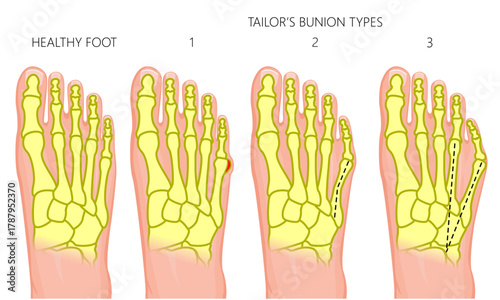 Healthy foot and Diagnosis of tailor bunion types