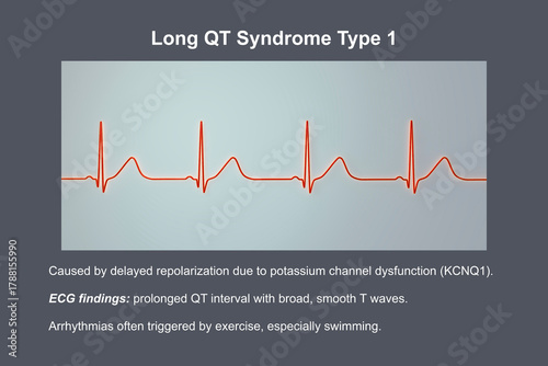 ECG in long QT syndrome type 1, 3D illustration, annotated