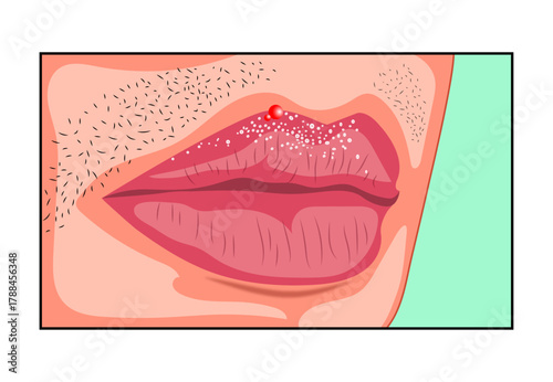 Fordyce Spots on Lips Illustration