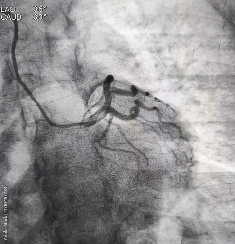 Coronary angiogram of left coronary artery during cardiac catheterization with contrast dye. Abnormal findings. Colour adjust.
