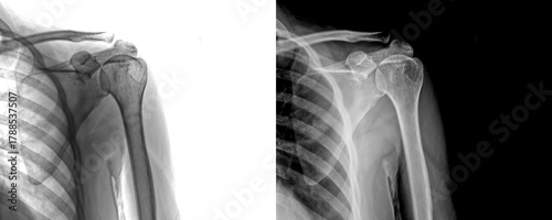 Fotografía Shoulder Anterior View Radiograph Displaying Bone Anatomy for Evaluation of Dege