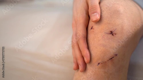 Male hand gently touches healing wound on knee with three stitched surgical incisions after ACL repair, realistic home setting. Concept of sports injury treatment, recovery and postoperative care