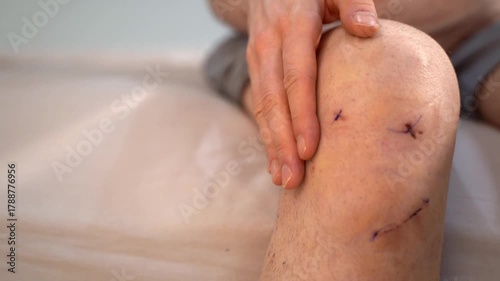 Man touches stitched knee after anterior cruciate ligament surgery, gently pressing around the healing incisions. Concept of self-monitoring, home care rehabilitation and tactile recovery assessment