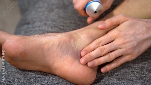 Hand applies clear soothing gel from tube to bruise on inner foot with purple wound. Concept of cooling aloe vera gel for post-contusion swelling, relief and natural plant-based aftercare therapy