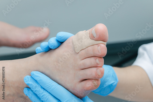 Close-up of bunion treatment on caucasian adult foot with medical bandage and gloves