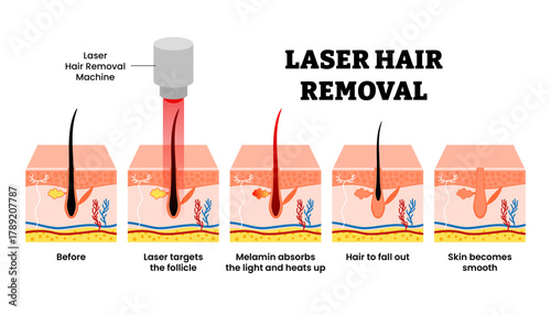Stages of Laser hair removal stage. Labeled laser target follicle, melamin absorbs and heat up, hair fall out. Before after procedure treatment session. Dermatology vector illustration.