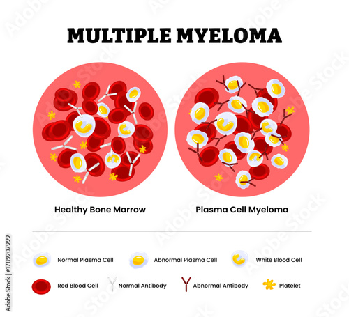 Healthy bone marrow vs plasma cell myeloma specimen blood composition comparison. Human blood cells structure. Thrombocytes, leukocytes, erythrocytes under microscope. Microbiology test. Blood disorde