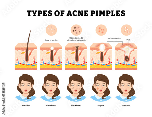 Different types of acne pimples type with girl or woman character. Labeled whitehead, blackhead, papule, pustule, pus inflammation, pore. Skin structure anatomy cross section. Vector illustration.
