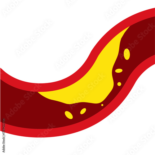 Medical Illustration of Cholesterol Buildup in Artery