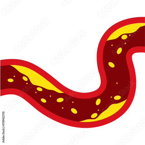 Medical Illustration of Cholesterol Buildup in Artery