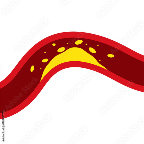 Medical Illustration of Cholesterol Buildup in Artery