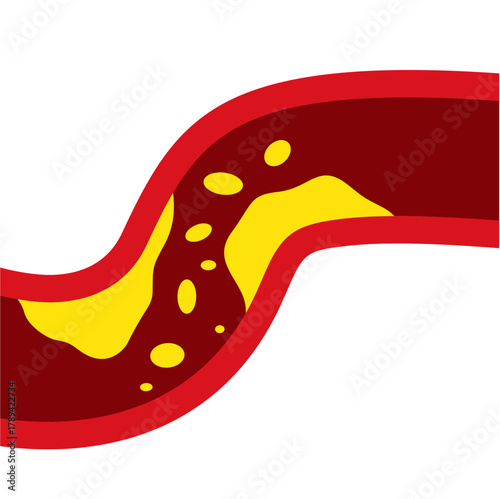 Medical Illustration of Cholesterol Buildup in Artery