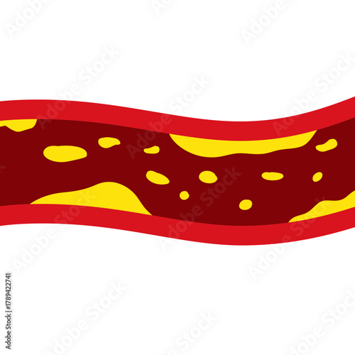 Medical Illustration of Cholesterol Buildup in Artery