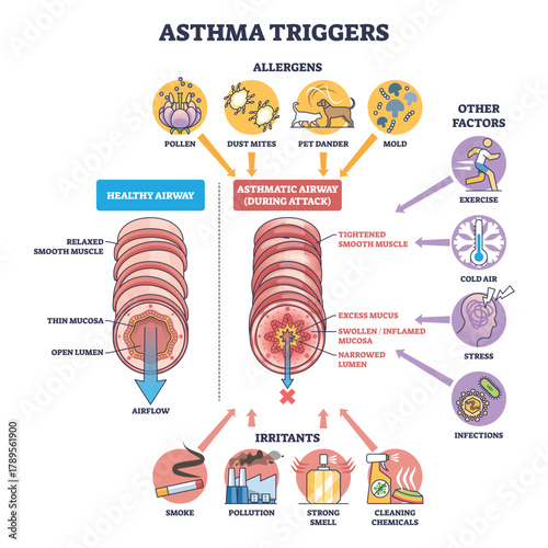 Asthma triggers diagram shows healthy vs asthmatic airway with allergens and irritants causing swelling and mucus, key objects, airway cross-sections, pollen, smoke. Outline diagram