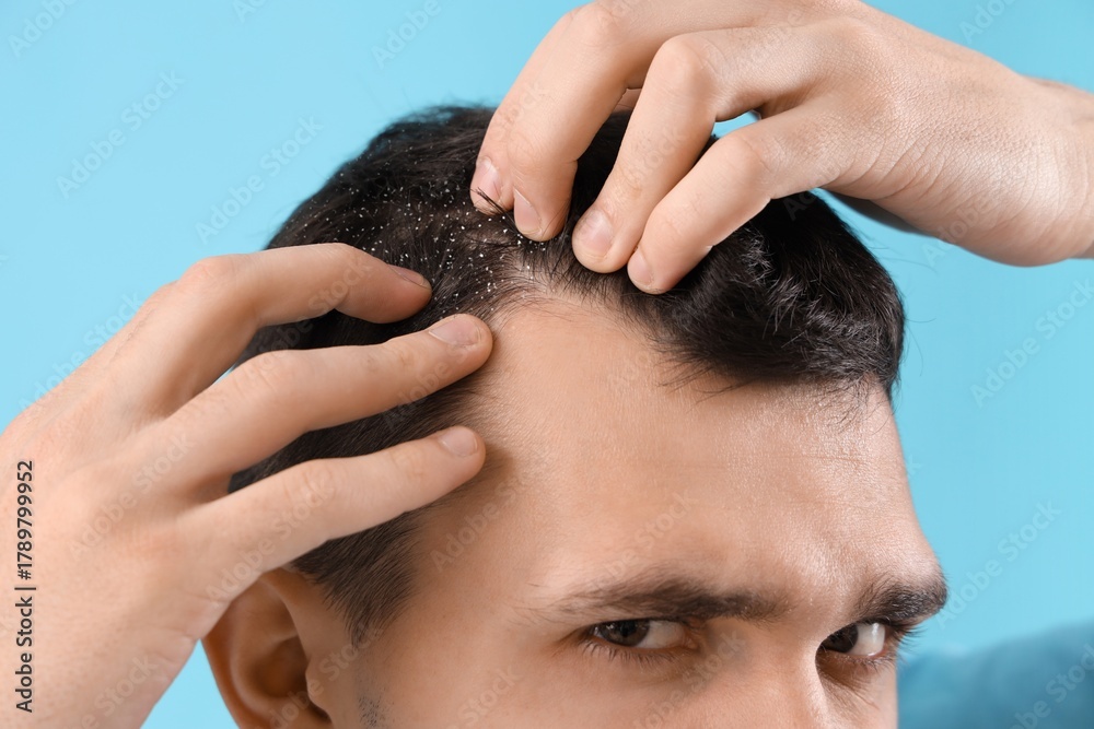 Fototapeta premium Young man with dandruff on blue background, closeup