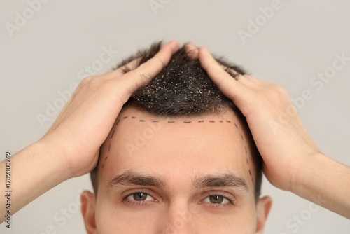 Young man with hair loss pr...