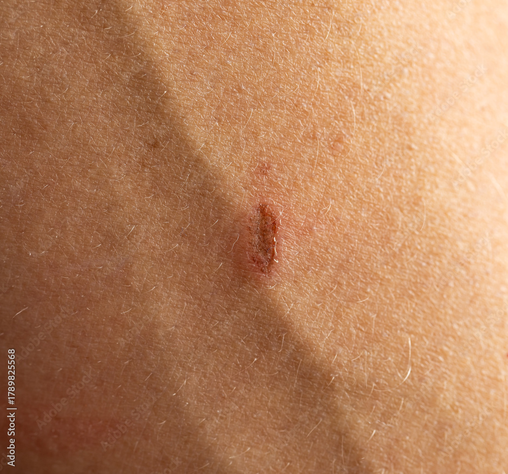 Fototapeta premium A person has a scar on their arm